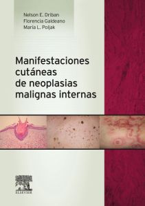 Manifestaciones cutáneas de neoplasias malignas internas